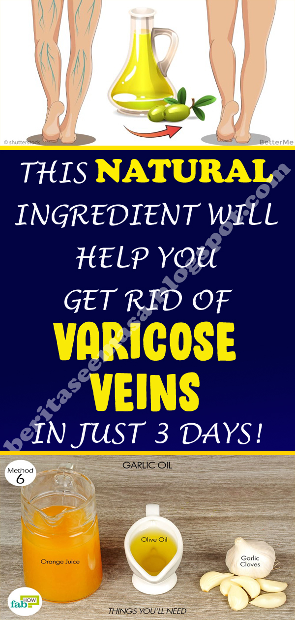 This NATURAL Ingredient Will Help You Get Rid of Varicose Veins in Just