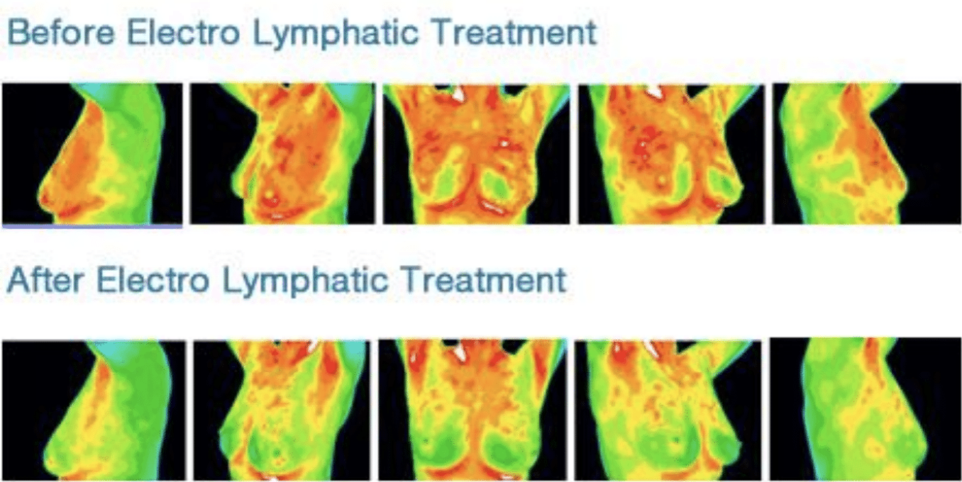 What is Lymphatic Drainage