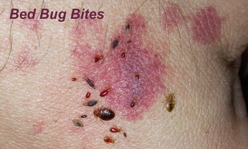 Insect Bites And Stings - Bed Bug Bites