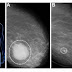 Scientists Have Created a Combination That Destroys Breast Cancer Tumors in 11 Days without Chemo