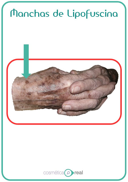 Cómo eliminar las manchas en las manos: Lipofuscina
