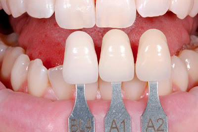 Bọc răng sứ nên áp dụng vào trường hợp nào?
