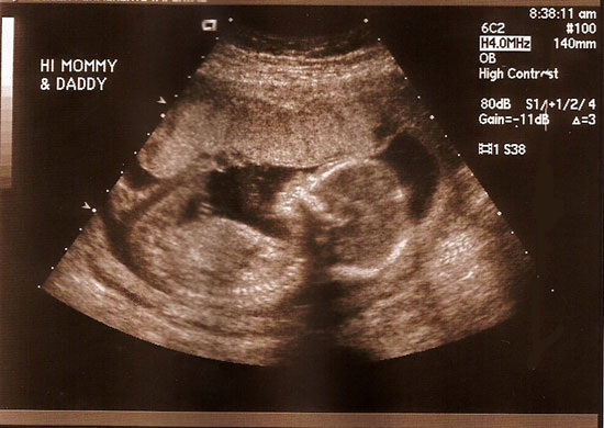 baby gender predictor 100