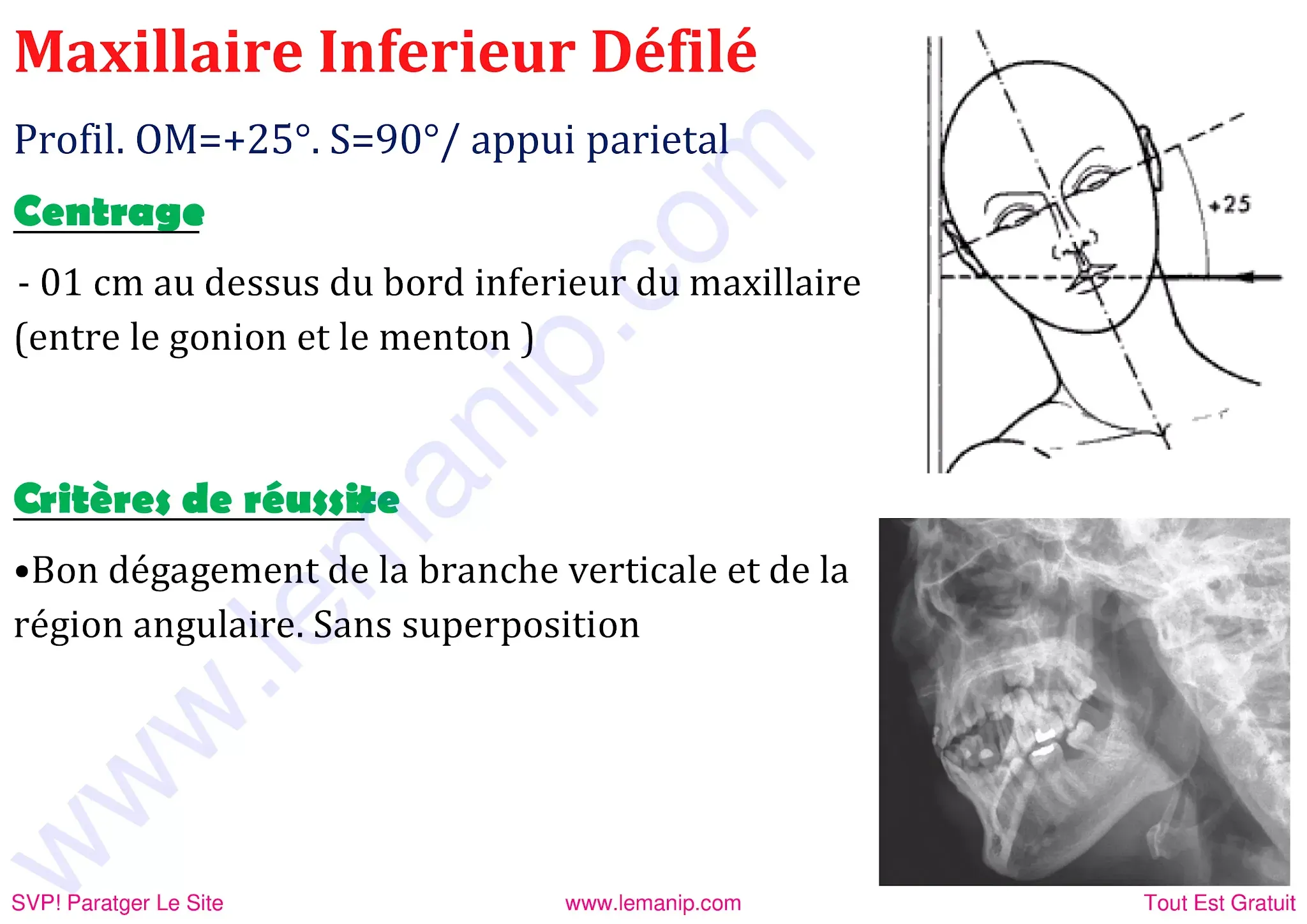 Maxilaire inferieur dffile