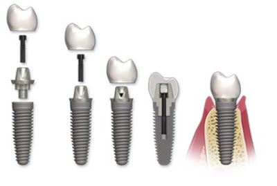 trong-rang-implant-mat-bao-lau