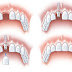 Trồng răng implant tại Nha Khoa Đăng Lưu