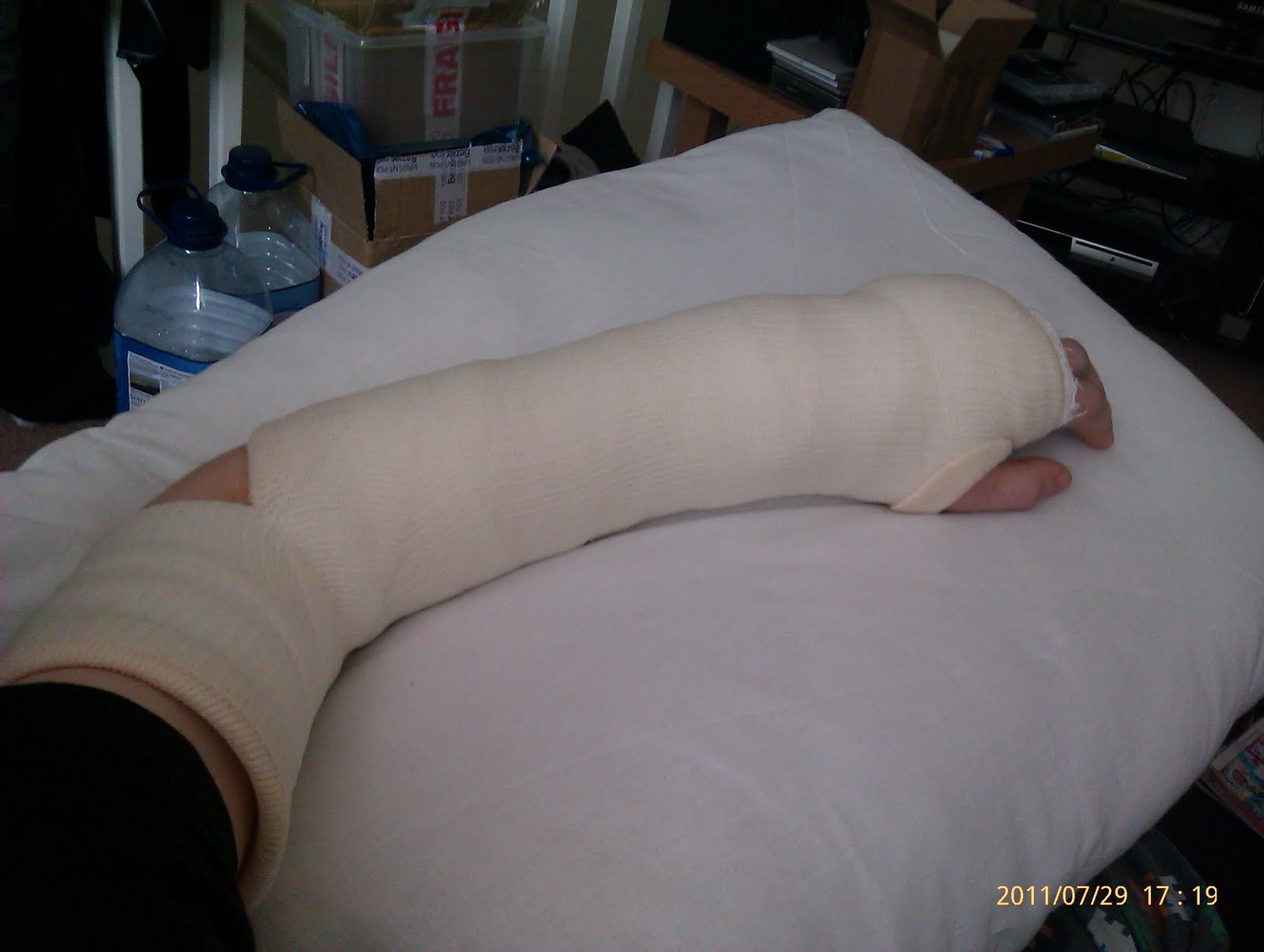 Katies bits and blogs Wrist fusion surgery S