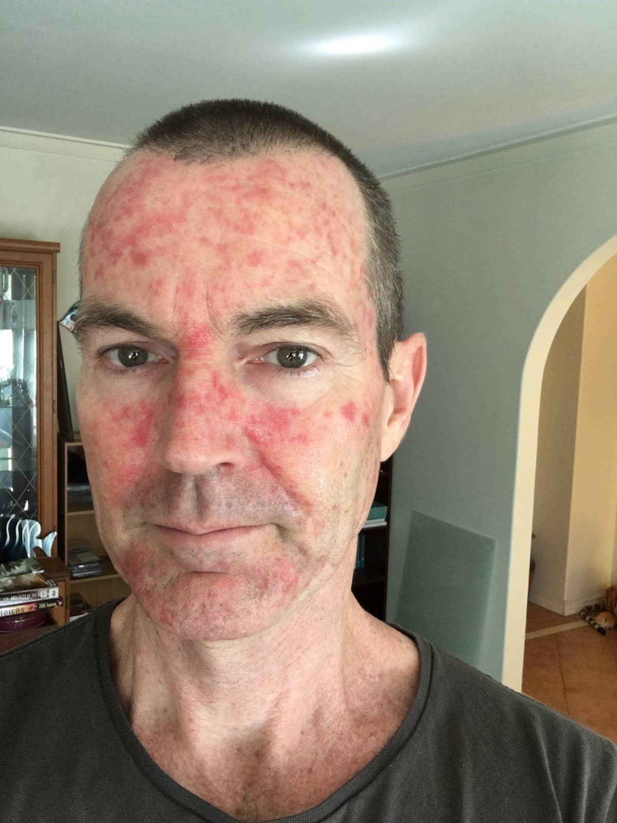 treatment cream efudix stop before march