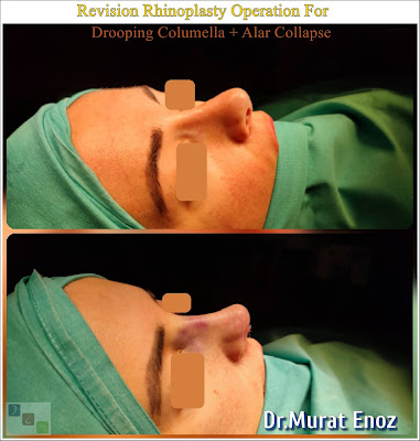 Revision Nose Job Turkey,Revision Rhinoplasty Operation in Istanbul,