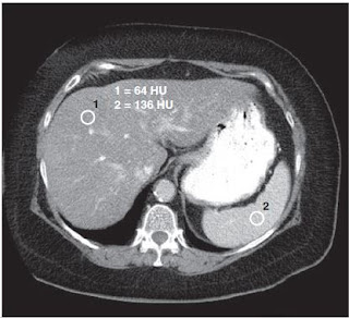 liver ct scan