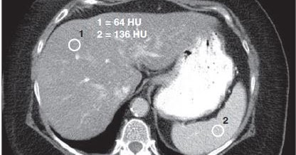 Normal Liver CT Scan