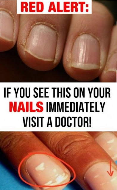 Red Alert: If You See This On Your Nails Immediately Visit A Doctor ...