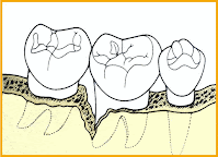 <Img src ="Recolonización-de-la-bolsa.gif" width = "1054" height "762" border = "0" alt = "Recolonización de la bolsa periodontal.">