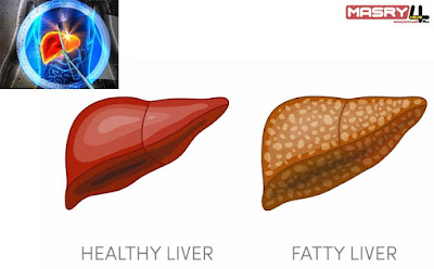 الأسباب وكيفية الشفاء و هل دهون الكبد خطيرة  Is fatty liver dangerous - causes and treatment