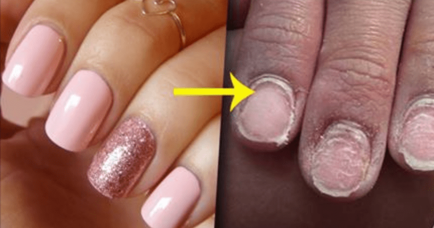 Портит ли ногти. Последствия гель лака для ногтей. Последствия шеллака для ногтей. Содранное покрытие с ногтей.