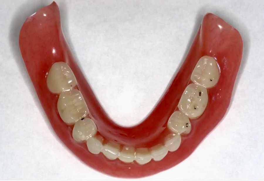 PROSTHODONTICS The Chew Test Diagnosing & Adjusting Denture Occlusion