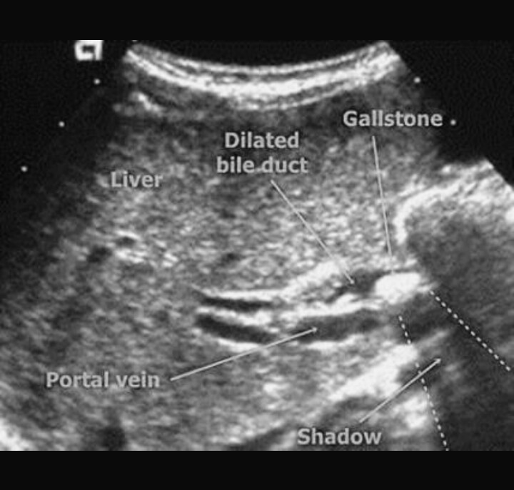 medical study OBSTRUCTIVE JAUNDICEDETAIL_causescure and symptoms
