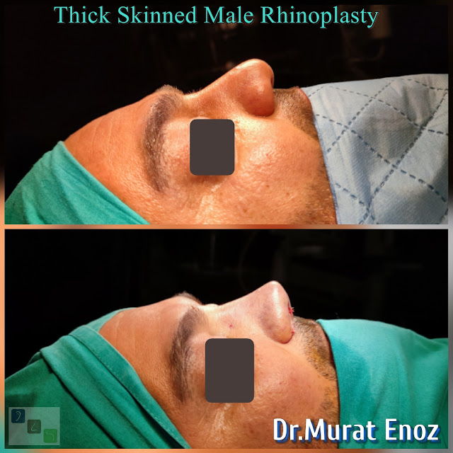 thick skinned rhinoplasty for men - oily thick skinned nose job