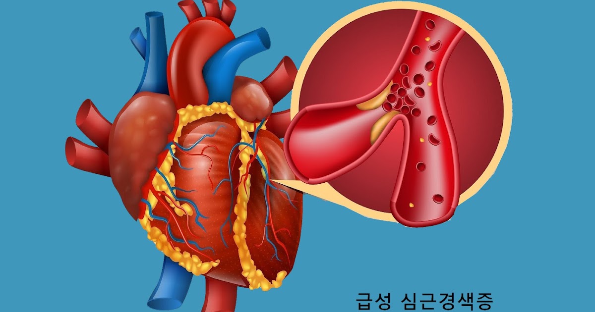 급성심근경색 의심 진단비는 얼마인가요? 7