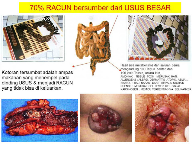 racun usus,akibat racun usus,