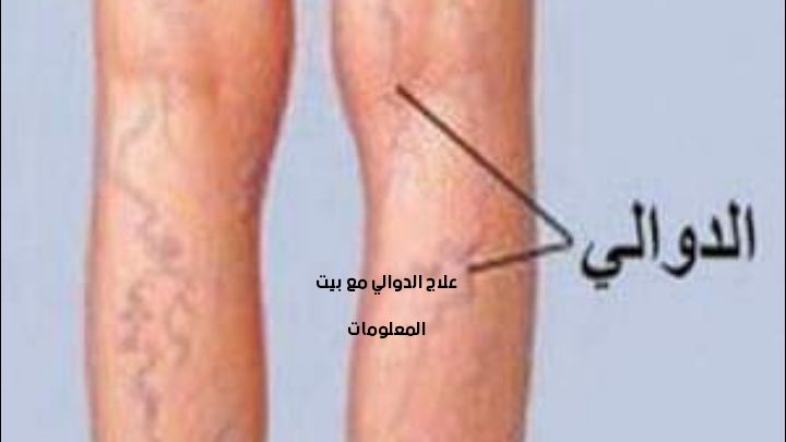 الأعشاب والزيوت لعلاج الدوالي