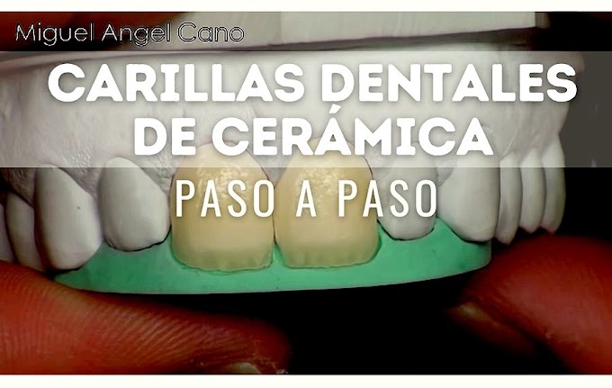 CARILLAS DENTALES de cerámica paso a paso - Miguel Angel Cano