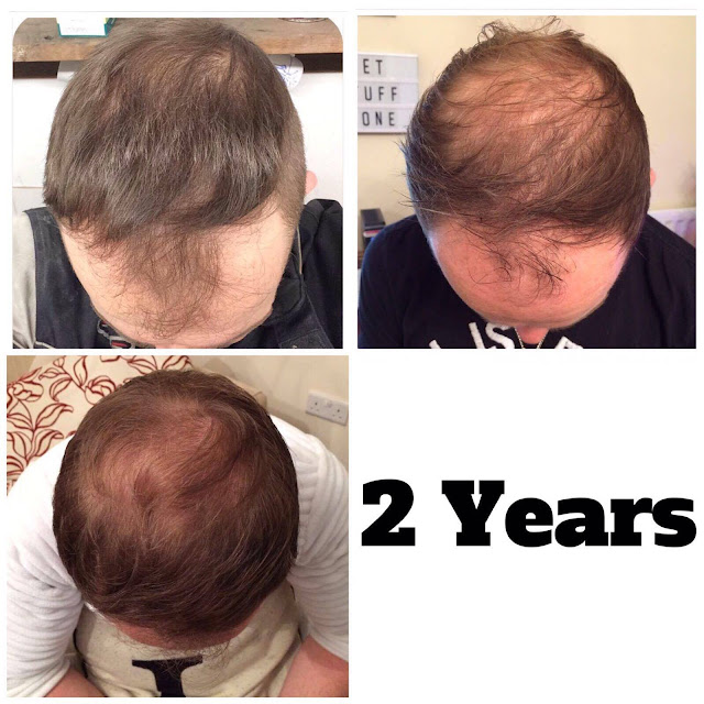 male pattern baldness Finasteride and Theradome results