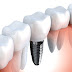 Có cần gây mê khi trồng răng implant ?