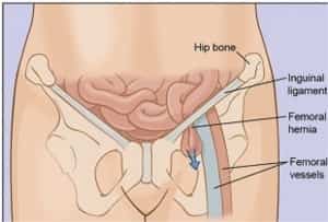 femoral hernia is affects on women