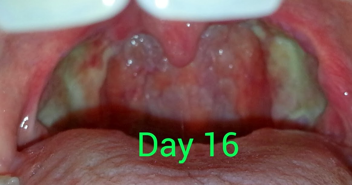 Jill s Tonsillectomy Day 17 jill-s-tonsillectomy-day-17