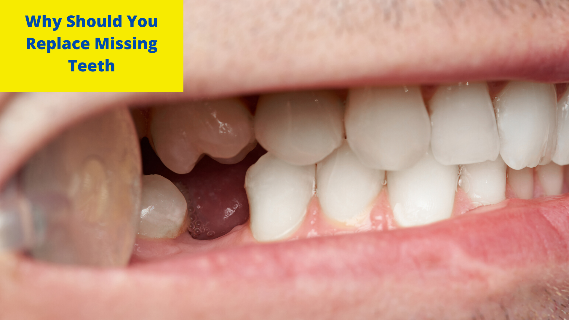 How Can I get Missing Teeth Replaced?