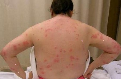 Mite Bites Warning Signs and Natural Treatments 2017 ...