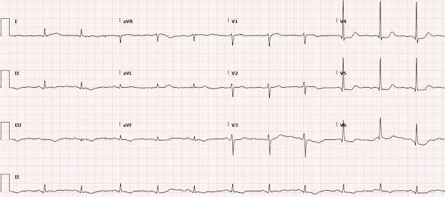 Another diagnostic ECG of a potentially deadly condition