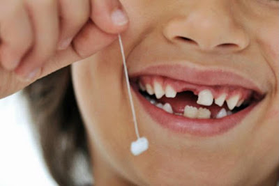  Trẻ chậm thay răng sữa làm thế nào?