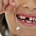 Nguyên nhân khiến trẻ chậm thay răng sữa 