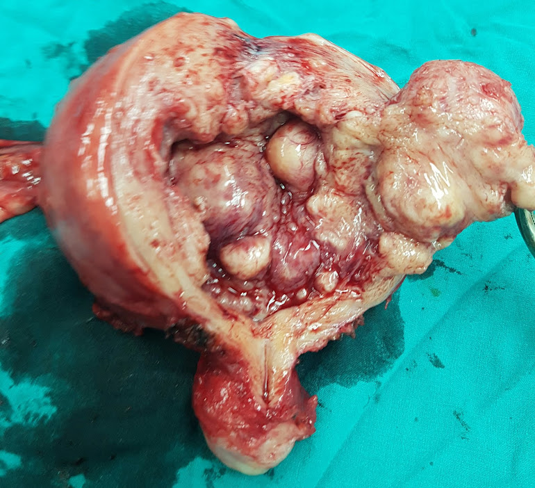 Hysterectomy for a case with endometrial polyps, adenomyosis and uterine fibroids by Dr.Alaa Mosbah