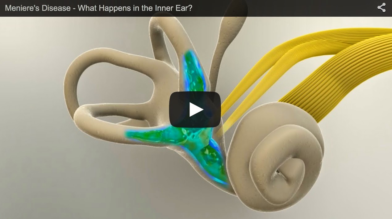 Video of Meniere's Disease (What Happens in the Inner Ear) Fauquier