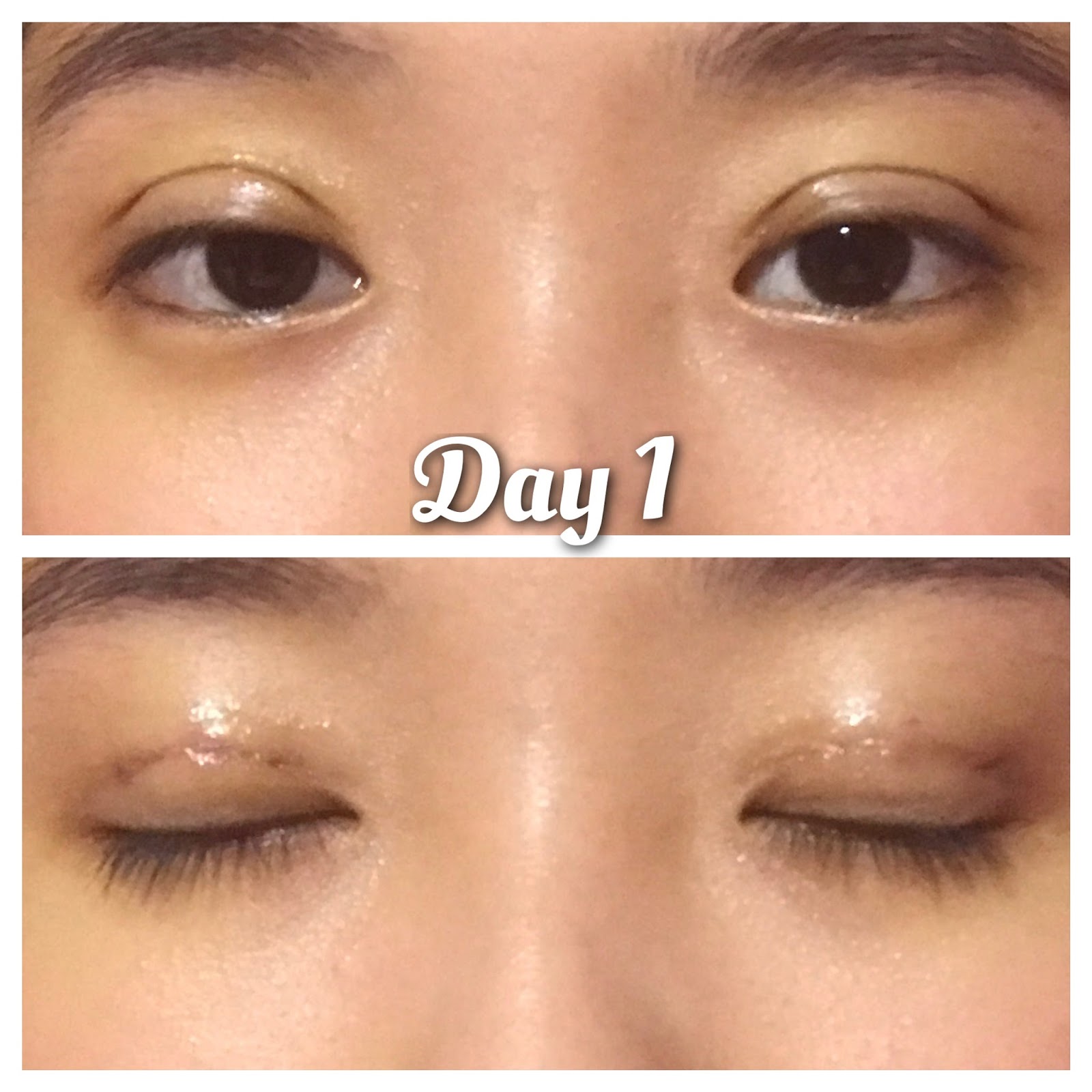 Journey of my Double Eyelid Procedure CHERMIEEE!!