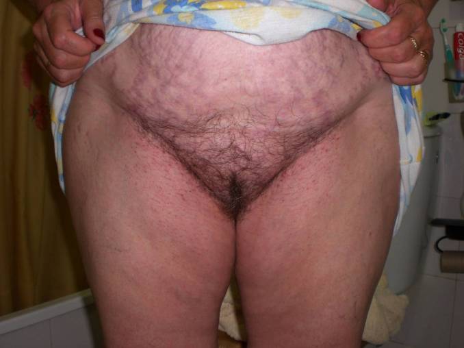 stretchmark belly chubby granny exposing hairy pussy