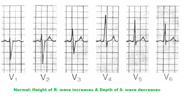 ventricular-hypertrophy