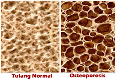 Massa tulang osteoporosis