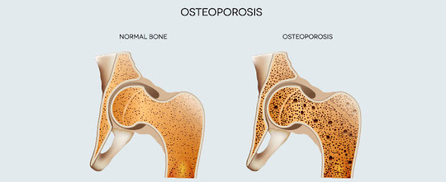 Bone health Bone health