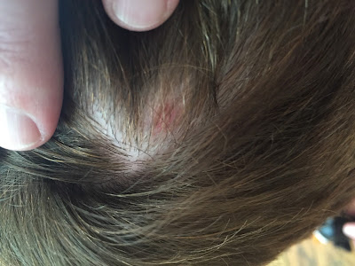 Skin irritation cause by CI headpiece