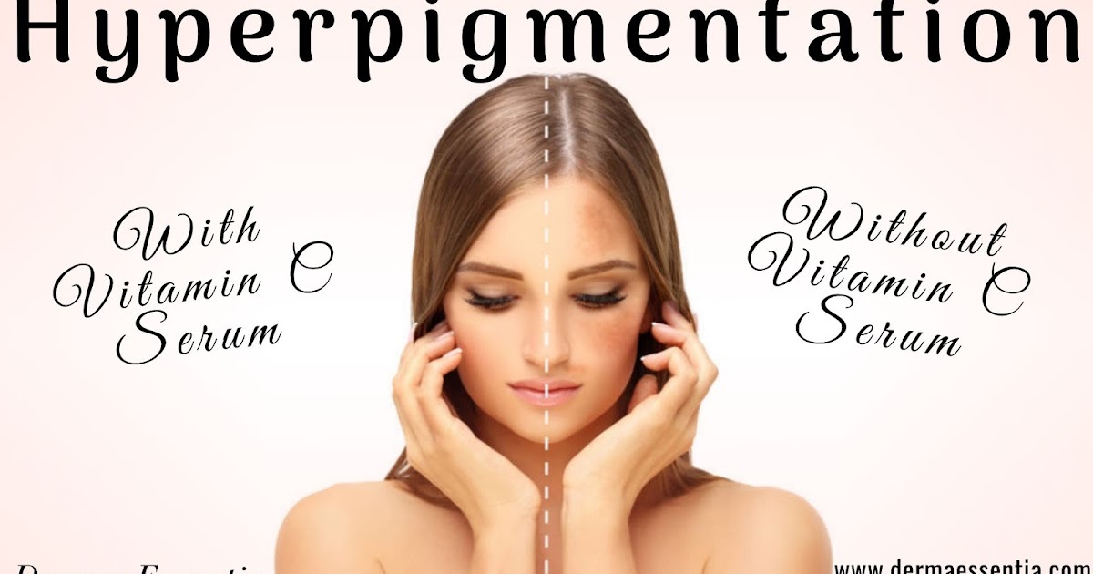 Does Vitamin C Help in Hyperpigmentation?