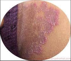 nama obat gatal untuk Selangkangan pantat atau bokong di apotik ampuh nama obat gatal untuk Selangkangan pantat atau bokong di apotik ampuh