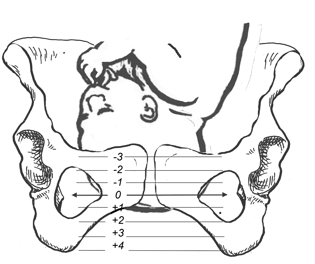 Unraveling the Mystery of NonEngagement Spinning Babies