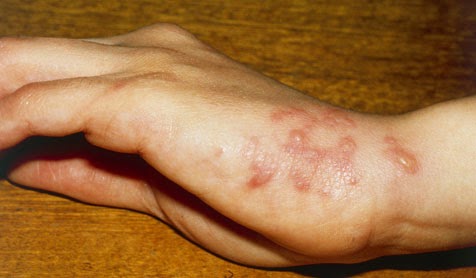rash on side of feet