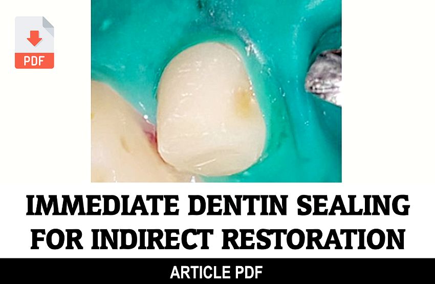 PDF Immediate Dentin Sealing for Indirect Restoration Why and How?