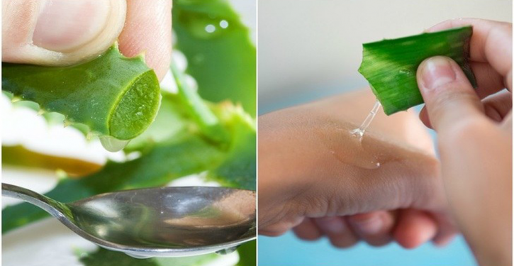 Use Aloe Vera To Treat Eczema, Psoriasis, Atopic Dermatitis And Other Skin Allergies