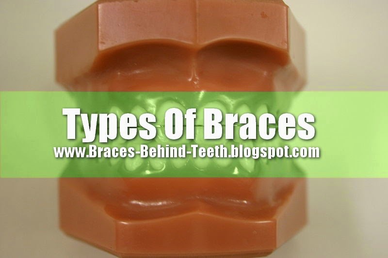 Types Of Braces